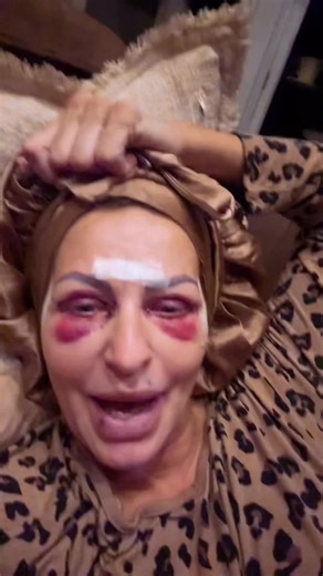 Day 2 of my recovery 😳😆 | recovery