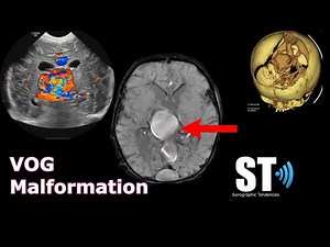 Vein of Galen Malformation (Aneurysm)