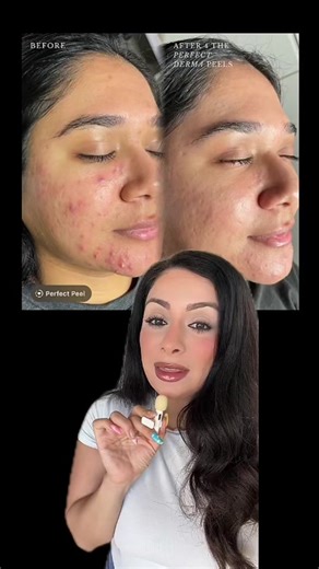 The Perfect Derma™ Peel on TikTok