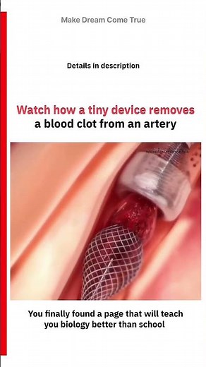 🩸 Watch how a tiny device removes a blood clot 🫀 from an artery 🧑‍⚕️ | MDCT