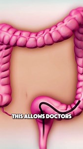 336K views · 1.1K reactions | How Colonoscopy Procedure Is Performed? (3D Animation) #colonoscopy #coloncancer #colonoscopyprocedure #colonhealth #colonscreening #medical3danimation #3dmedicalanimatiom #coloncancertreatment | Surgery Page | Facebook