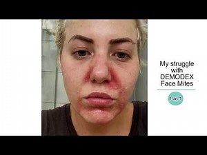 SHOCKING pics of My struggle with DEMODEX Face Mites - PART 1