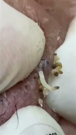 1 blackhead = 1$ haha