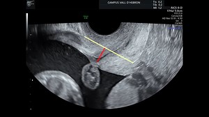 Real-time ultrasound demonstration of uterine isthmus contractions during pregnancy - Bladder pressing technique to identify the tip of the bladder reflection https://ow.ly/y7bQ50QmIqY | American Journal of Obstetrics & Gynecology