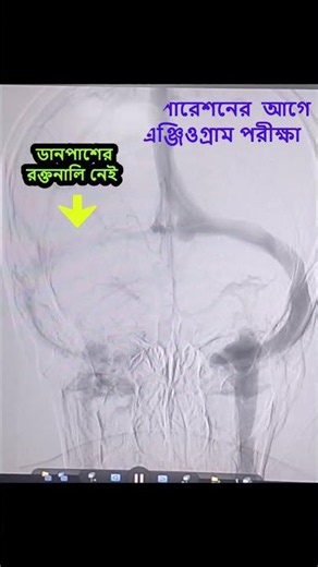Transverse sinus balloon angioplasty of IIH patient. Dr aminur Rahman