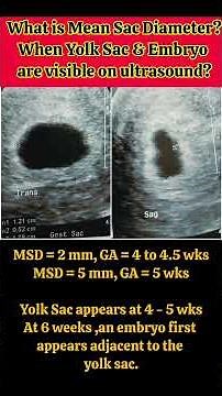 What is Mean Sac Diameter ?#embryo