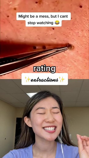 Pimple Extraction Facial | Oddly Satisfying Acne Removal