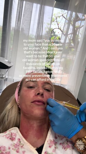Have you ever had your own plasma injected as fillers into your under-eye area and nasolabial folds? IT ROCKS