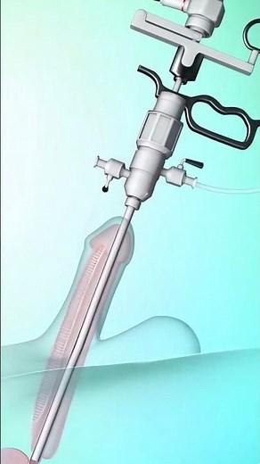 How TURP Surgery Removes Prostate Blockage Explained