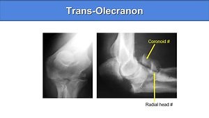 Olecranon Fractures
