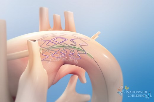 Hybrid Stage 1 Procedure