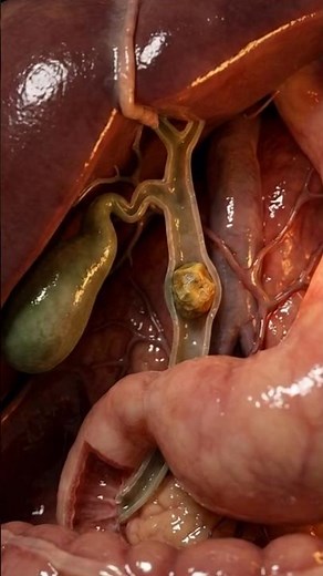 What If a Gallstone Blocks Your Bile Duct? | Dangerous Symptoms