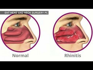 RhinAer Procedure - Relief from Chronic Runny Nose & Drainage