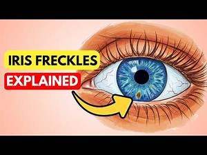 Understanding Iris Freckles