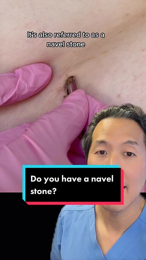 What is an Umbolith or Navel Stone? Removal and Prevention Tips
