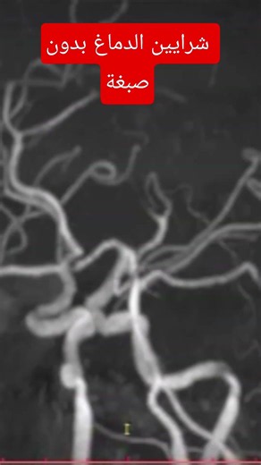 🧠 شرايين الدماغ بالرنين المغناطيسي بدون صبغة #MRA #MRI #الأشعة #Radiology