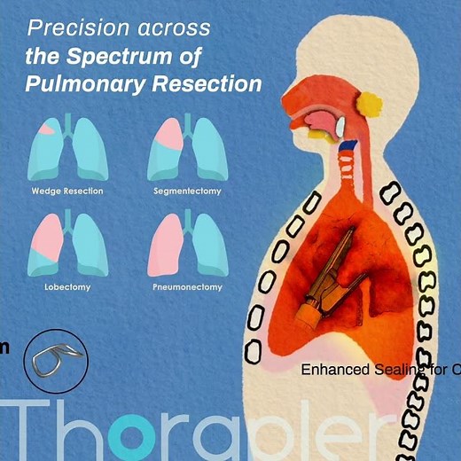 Fulbright Thorapler—Pulmonary resection