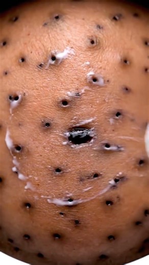 Pimple Extraction and Skincare Routine