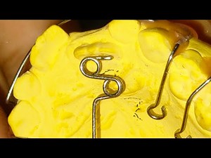 Z-Spring Of Ortho and posterior Bit Plane By Haider..