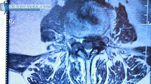 What is Disc Herniation?