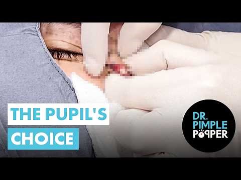 Pupil's Choice: A Satisfying Near-Eye Cyst