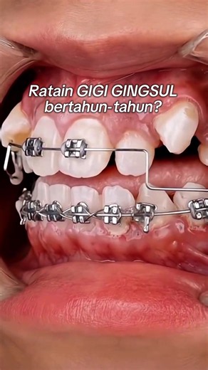 Cepat Hilangkan Gigi Gingsul dengan Aligner: 3–6 Bulan