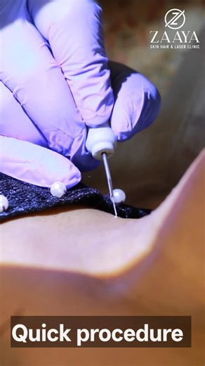 Safe. Simple. Scar-conscious skin tag, mole & wart removal✨