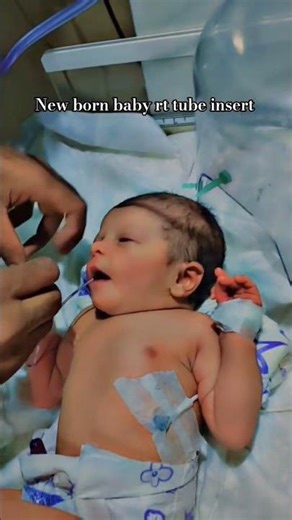 Newborn NG Tube Placement | NICU Skills for Nurses #DrAmirAIIMS #NeuroSurgery #MMC #SelectHospital