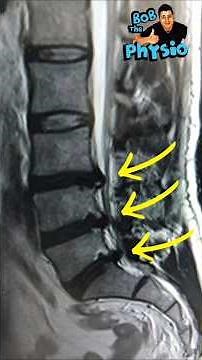 They Told Him: ‘NO LIFTING OR YOU’LL BE PARALYSED’… Here’s What Happened