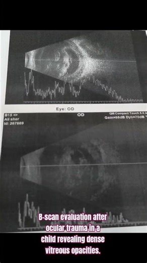 Trauma case: B-scan demonstrating vitreous echoes suggestive of post-traumatic vitreous hemorrhage.
