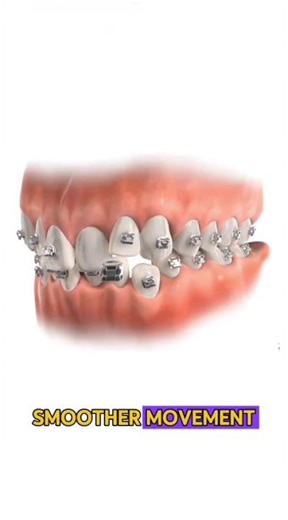 ✨ Self-Ligating vs Traditional Braces — What’s the Difference?