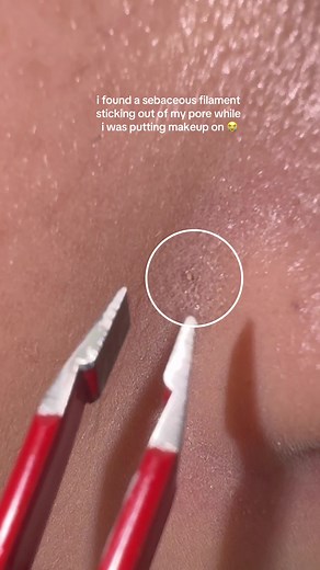 Satisfying Sebaceous Filament Removal | Clear Skin Secrets