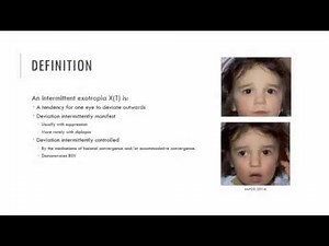 Intermittent Exotropia Characteristics