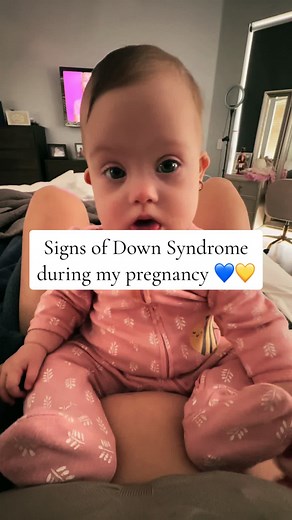 Recognizing Signs of Down Syndrome During Pregnancy