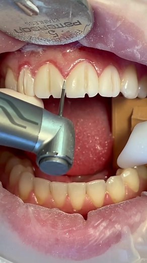 How to Remove Temporary Crown: Dental Tips
