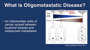 VIDEO: Management of Oligometastatic Prostate Cancer: From Imaging to Therapy - Prostate Cancer Patient Conference 2022