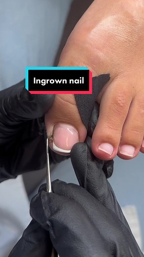 Regrowing Beautiful Toenail for 6 Months | Medical Pedicure