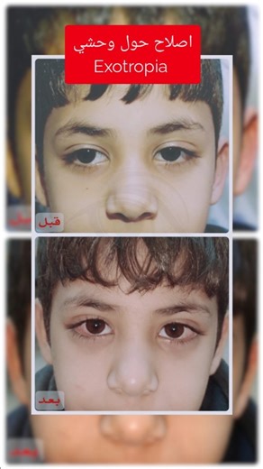Dr.Mohammad Khabbaz on Instagram‎: "اصلاح حول وحشي متناوب alternating exotropia repair by bilateral lateral rectus recession #طبيب_عيون #حول #eyes #ophthalmology #strabismus"‎