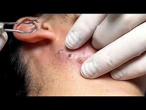 Ultimate Ear Pimple Cluster Pop! So Satisfying 🤯✨
