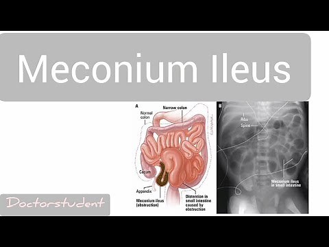 Meconium Ileus