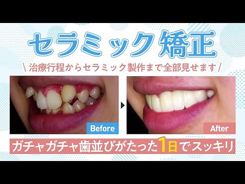 【これでわかるセラミック矯正】ガチャ歯を治して笑顔❤治療・製作風景をしっかり見せます【湘南美容クリニック・歯科仙台院柿野医師・歯科矯正】