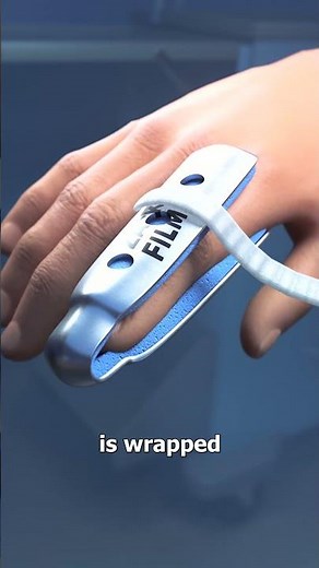 How Finger Splints Work 🤨