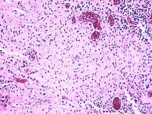 Typhoid Fever & Salmonella typhi