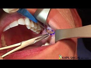 AWAKE Buccal Fat removal!