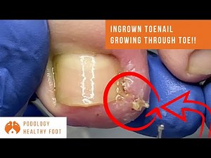 Ingrown toenail GROWING THROUGH TOE! ***in a Relaxing ASMR***
