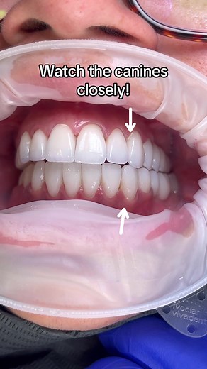 #canineguidance #occlusion #bite #veneers #porcelainveneers #fullmouthrestoration #teeth #dental