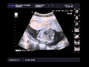 5th Month Scan of Baby in Womb