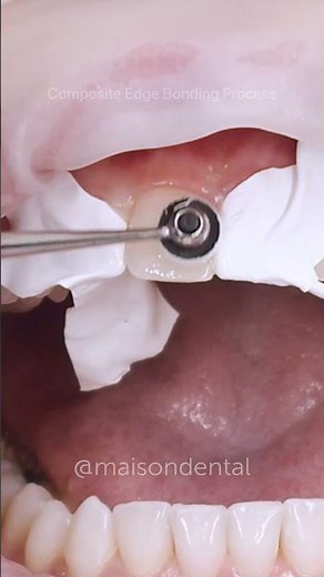 Composite edge bonding is where we apply the composite to the edge of the tooth to change its shape✨