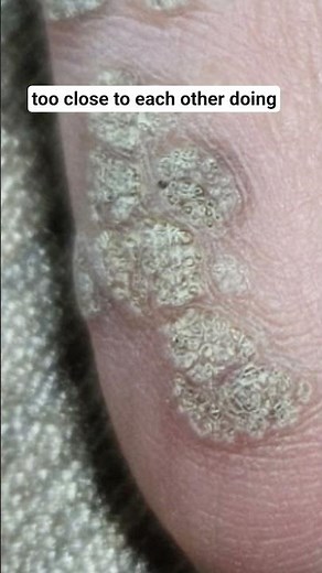 HPV Finger Warts: Complete Clearance Without Procedure No Burning Needed! Finger Warts gone