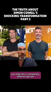 Simon Cowell's Plastic Surgery Changed His ENTIRE Face 😳 Let's break down why Simon looks so drastically different: Eyes & Eyebrows 👁️ Lower eyelid blepharoplasty complication feminized, arched eyebrows = a very female eye shape that doesn't match his face. His Smile (Facelift Evidence) 😬 His smile has been pulled and yanked back significantly. This can ONLY be achieved with a facelift. His entire smile has changed. Why This Matters 🎭 Eyes and smile are what make you recognizable. Change one